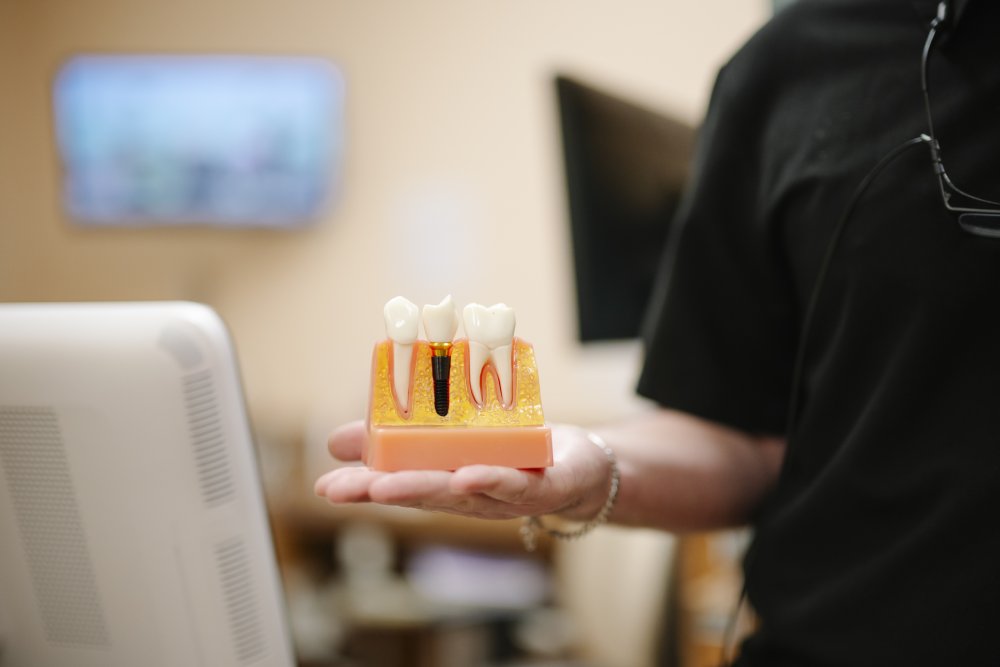 Dental implant model demonstration – Dentist in Naples, FL Dentist holding a dental model showing a tooth implant and surrounding teeth structure for patient education – Dentist in Naples, FL.